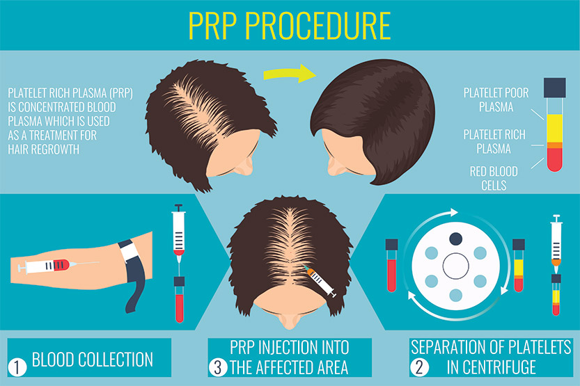 alopecia-treatment